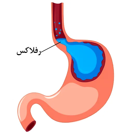 رفلاکس معده از موارد احتیاطی مصرف داروی آسپیرین و امپرازول